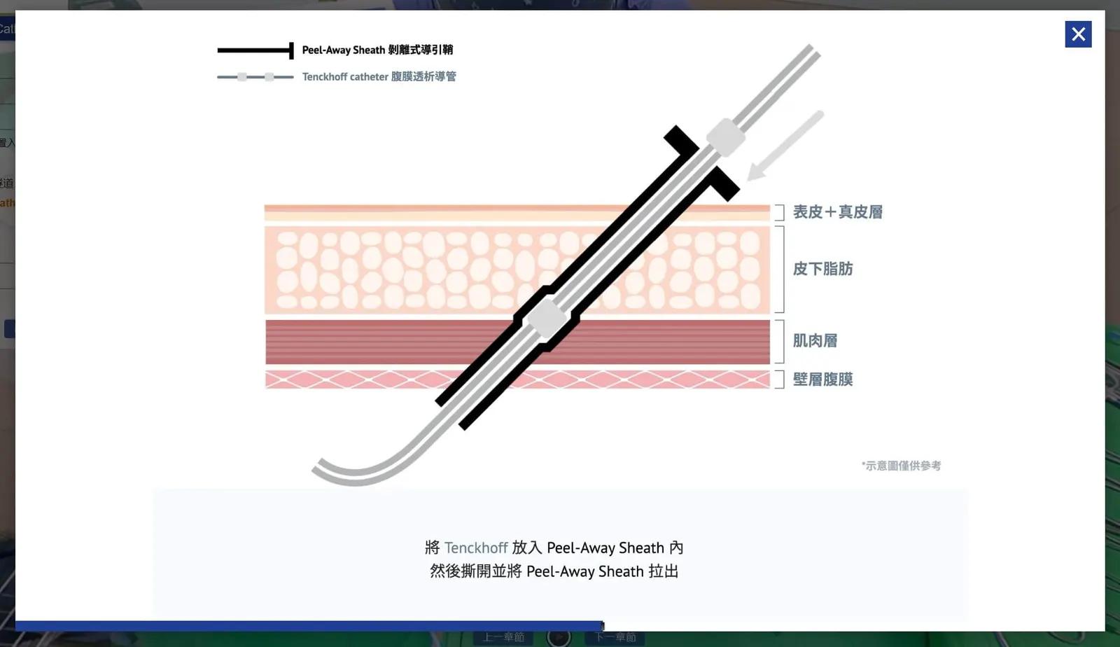 腹膜透析導管-經皮植管 手術 動畫 VR虛擬實境教材 XR教材應用